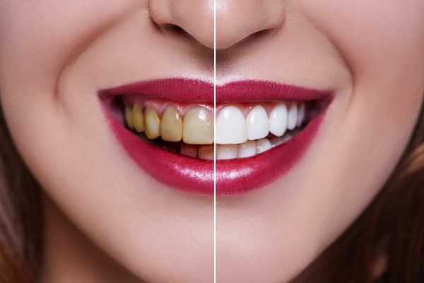 Tooth Bleaching